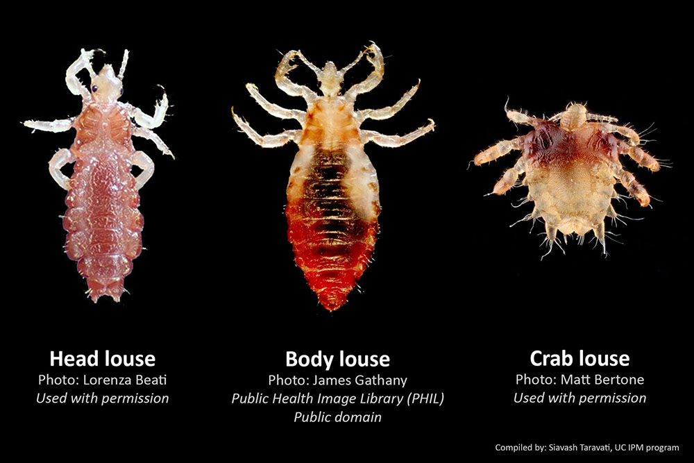 This photos shows different human lice species: head louse,body louse, and crab or public louse